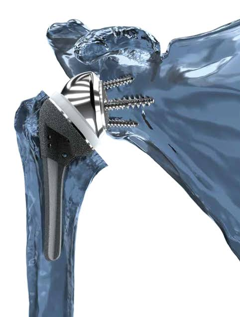 Reverse shoulder replacement implant model showing the glenosphere, baseplate screws, humeral stem, and polyethylene cup