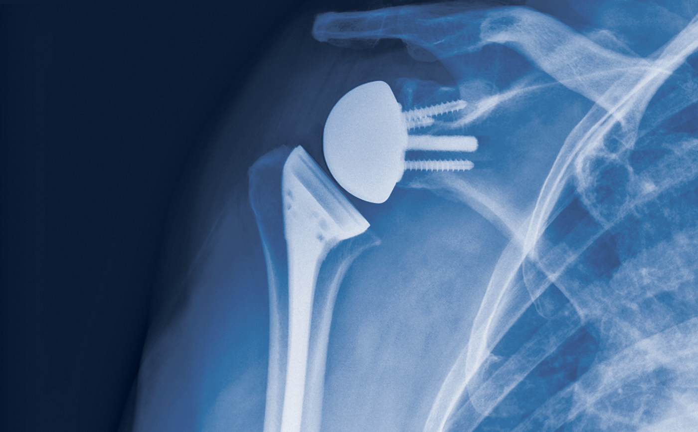 Postoperative X-ray showing restored anatomy after reverse shoulder replacement